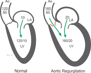 aortic regurgitation cardiac chamber pressures